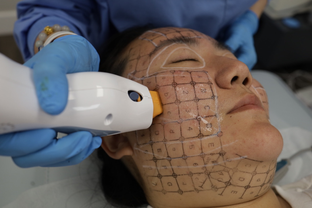 Training with Candela device